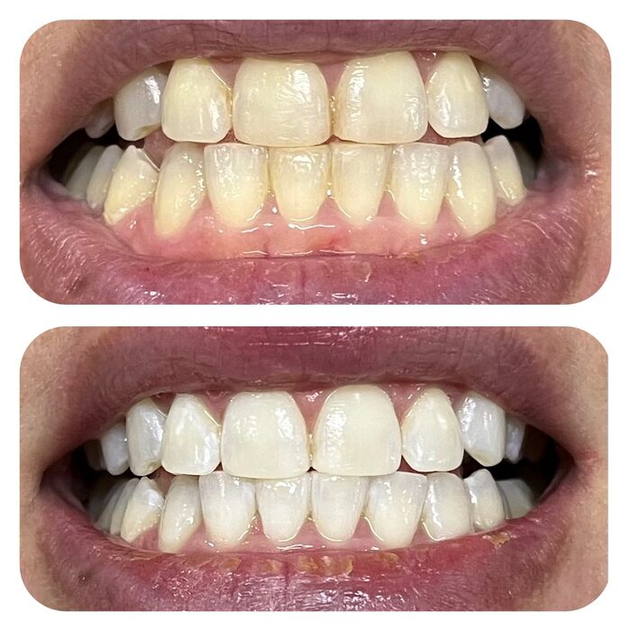 Blanqueamiento dental Rosario antes y después caso real