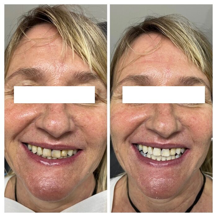 Blanqueamiento dental antes y después sonrisa ANYA Rosario