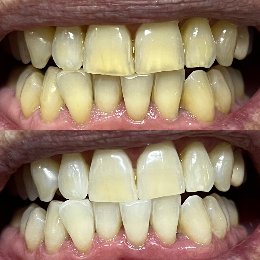 Blanqueamiento dental antes y después en Rosario · ANYA